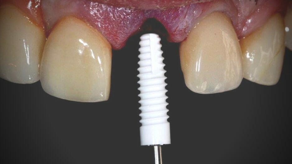 beclinique implantes dentários