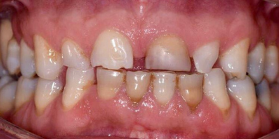 beclinique dental veneers