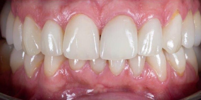 beclinique facetas dentárias