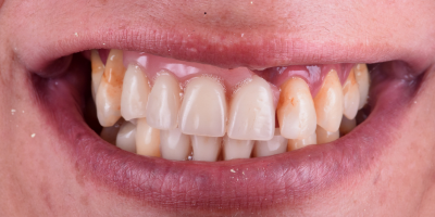 beclinique implantes dentários