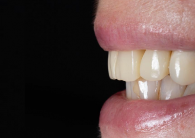 dentes em 1 dia — caso #2