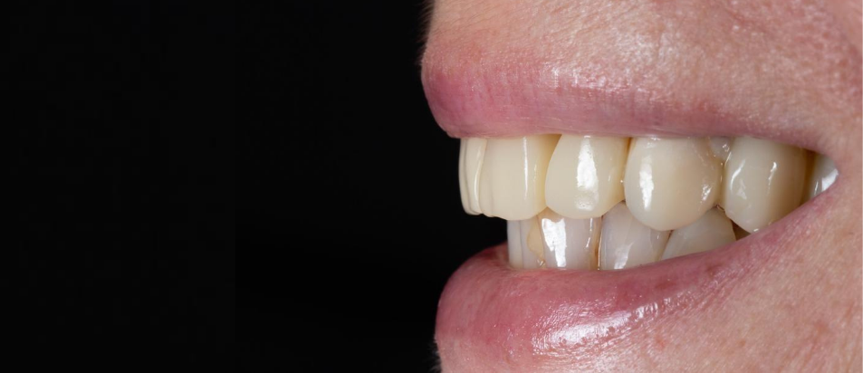 dentes em 1 dia — caso #2