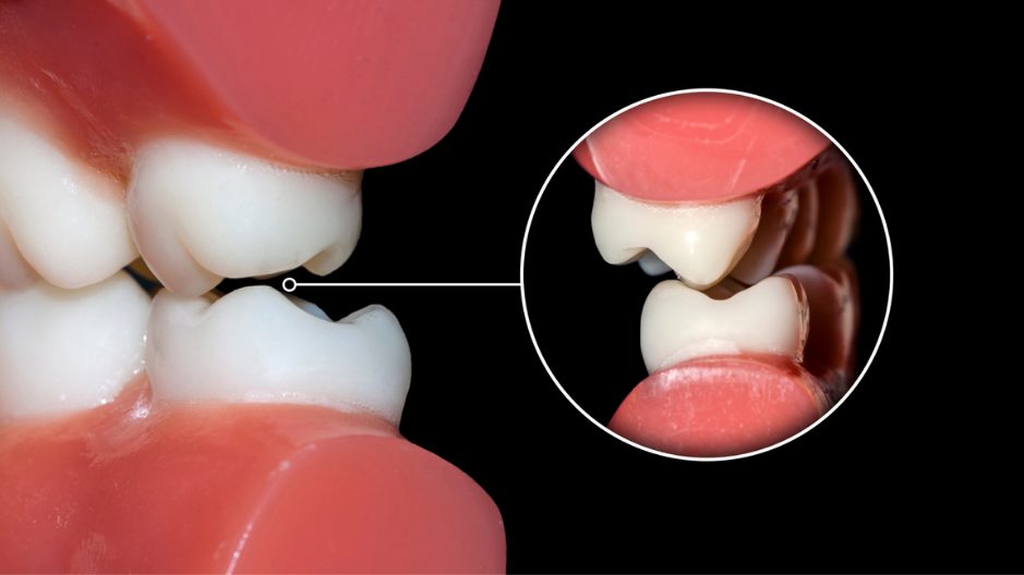 beclinique oclusão dentária