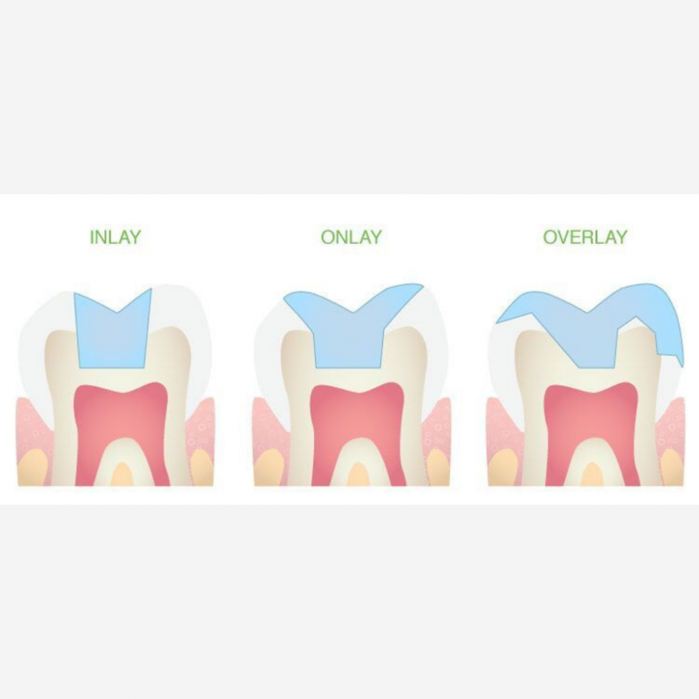 Inlays, Onlays e Overlays - BeClinique