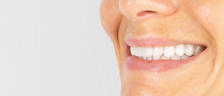 Facetas Dentárias — Caso Clínico #1