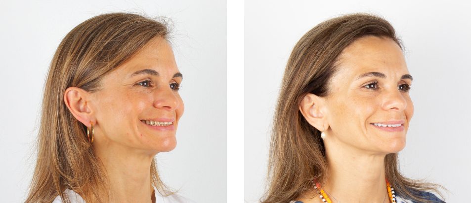 Facetas Dentárias - Antes e Depois Lateral - Beclinique