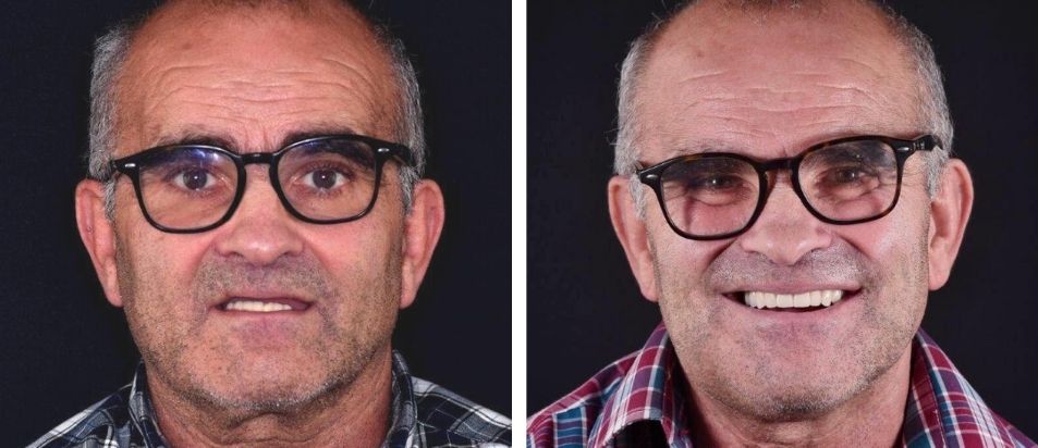 Antes e Depois beclinique caso clínico dentes em 1 dia #2