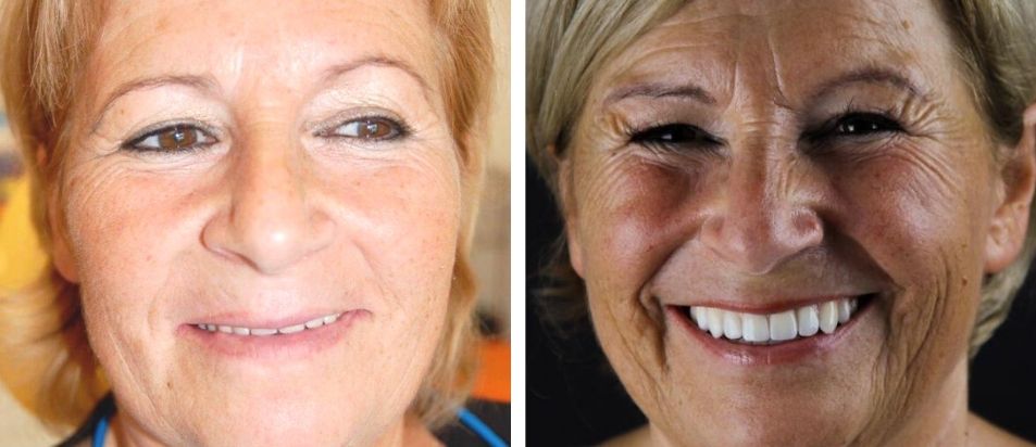 beclinique-caso-clínico-implantes-zigomaticos-#4 Antes e Depois beclinique caso clínico dentes em 1 dia #2