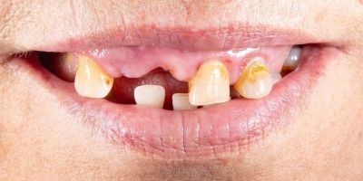 Laurinda Depois Implantes Dentários