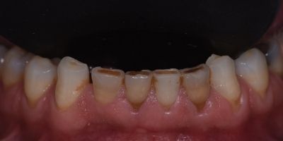 Facetas-Dentarias-Francisco-Antes-Depois-4 Facetas-Dentarias-Francisco-Antes-maxiliar-superior