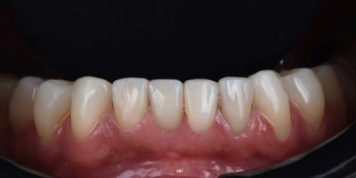 Facetas-Dentarias-Francisco-Antes-Depois-4 Facetas-Dentarias-Francisco-Antes-maxiliar-superior