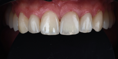 Facetas-Dentarias-Francisco-Antes-Depois Facetas-Dentarias-Francisco-Depois