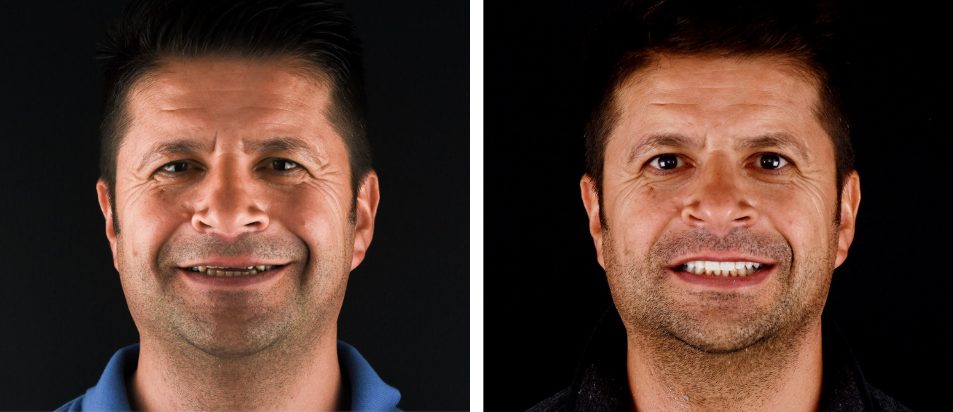 facetas-dentaria-antes-depois-francisco facetas-dentaria-antes-depois-francisco