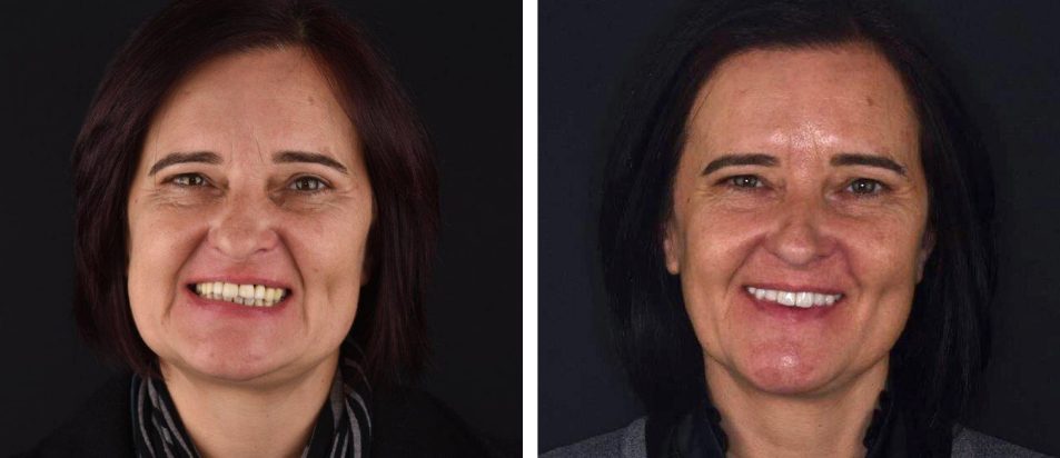 Ana-Monica-Leonardo-Antes-Depois-reabilitação-oral Reabilitação Oral Ana Monica Leonardo