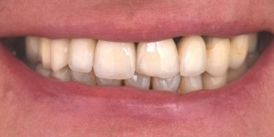 Reabilitacao-dentaria-Ana-Monica-depois Reabilitação Oral Ana Monica Leonardo Depois