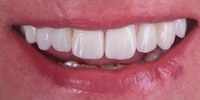 Reabilitacao-dentaria-Ana-Monica-depois Reabilitação Oral Ana Monica Leonardo Depois