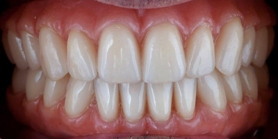 Laurinda Depois Implantes Dentários