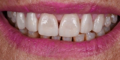 Site-beclinique-coroas-dentarias-dissilicato-caso-clinico-Maria-Antes-Depois Site beclinique coroas dentarias dissilicato caso clinico Maria caso Antes Depois