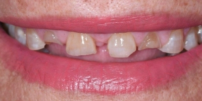 Site-beclinique-coroas-dentarias-dissilicato-caso-clinico-Maria-Antes-Depois Site beclinique coroas dentarias dissilicato caso clinico Maria caso Antes Depois