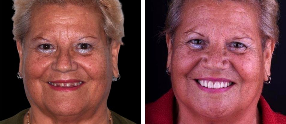 beclinique-coroas-dentarias-dissilicato-caso-clinico-Maria beclinique coroas dentarias dissilicato caso clinico Maria