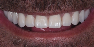Site-beclinique-Implantes-caso-clinico-Cristovao-Antes-Depois-3 Clinica Dentária Beclinique Implante Dentário Cristovão