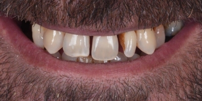 Site-beclinique-Implantes-caso-clinico-Cristovao-Antes-Depois-3 Clinica Dentária Beclinique Implante Dentário Cristovão