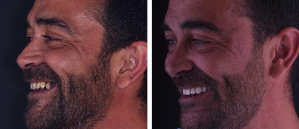 beclinique-implantes-dentarios-caso-clinico-Cristovao-2 Clinica Dentária Beclinique Implante Dentário Cristovão