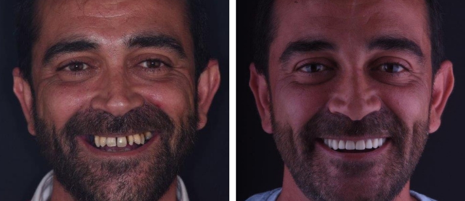 beclinique-implantes-dentarios-caso-clinico-Cristovao Clinica Dentária Beclinique Implante Dentário Cristovão