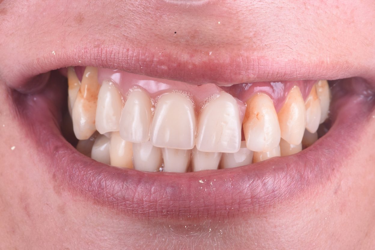 Dental Clinic Beclinique Dental Implant Cristovão