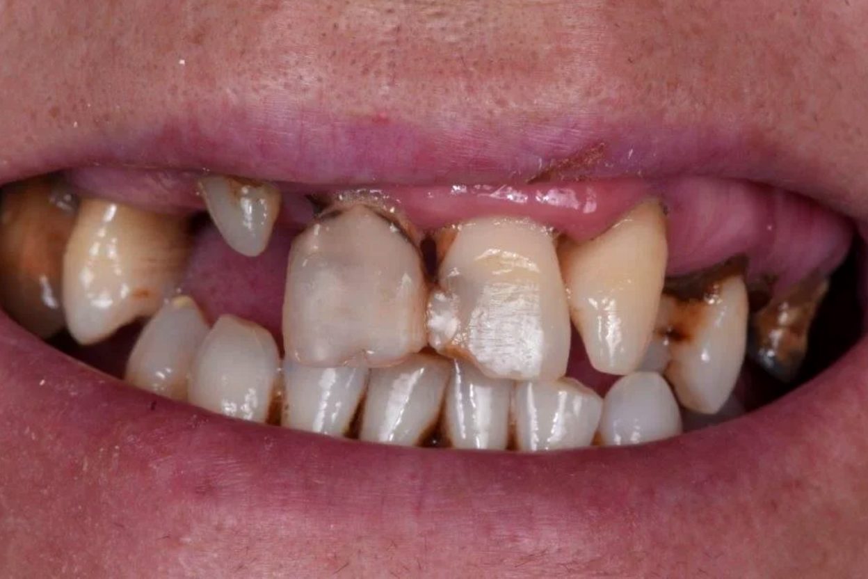 2 Total Rehabilitation Implants after MAria Santana