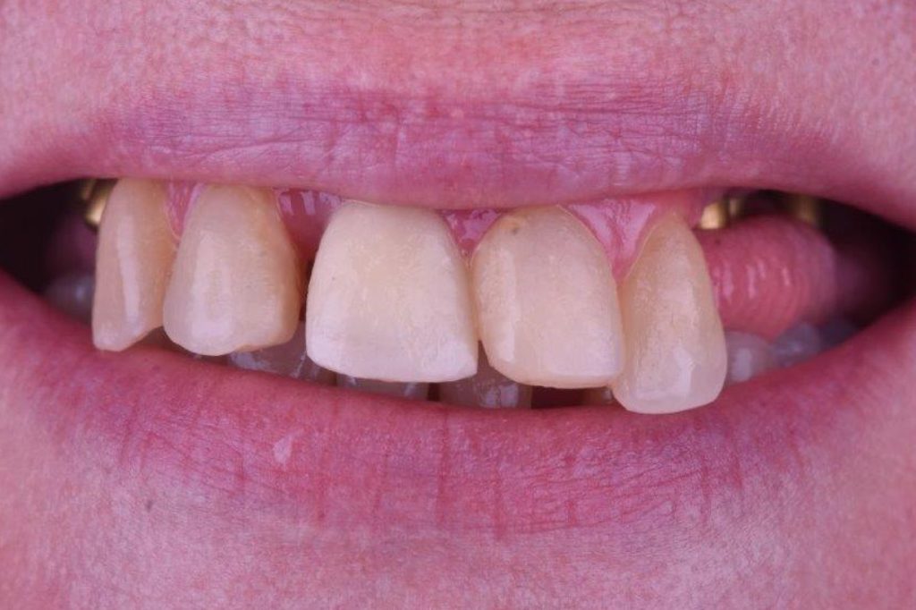 Dental Clinic Beclinique Dental Implant Cristovão