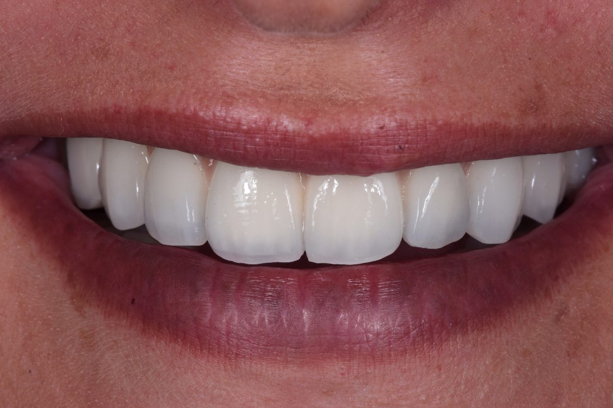 Dental Clinic Beclinique Dental Implant Cristovão