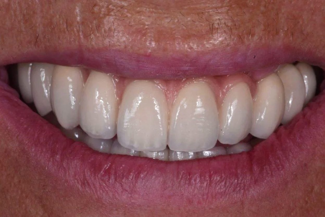 Total Rehabilitation Implants after MAria Santana