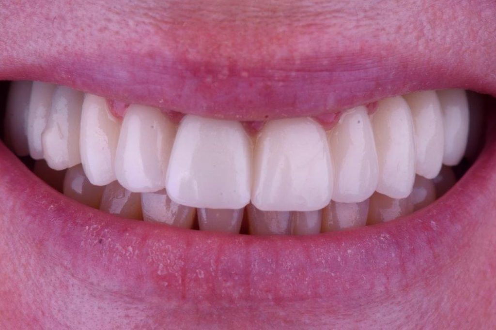 Dental Clinic Beclinique Dental Implant Cristovão