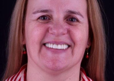 Dental Implants – Maria João