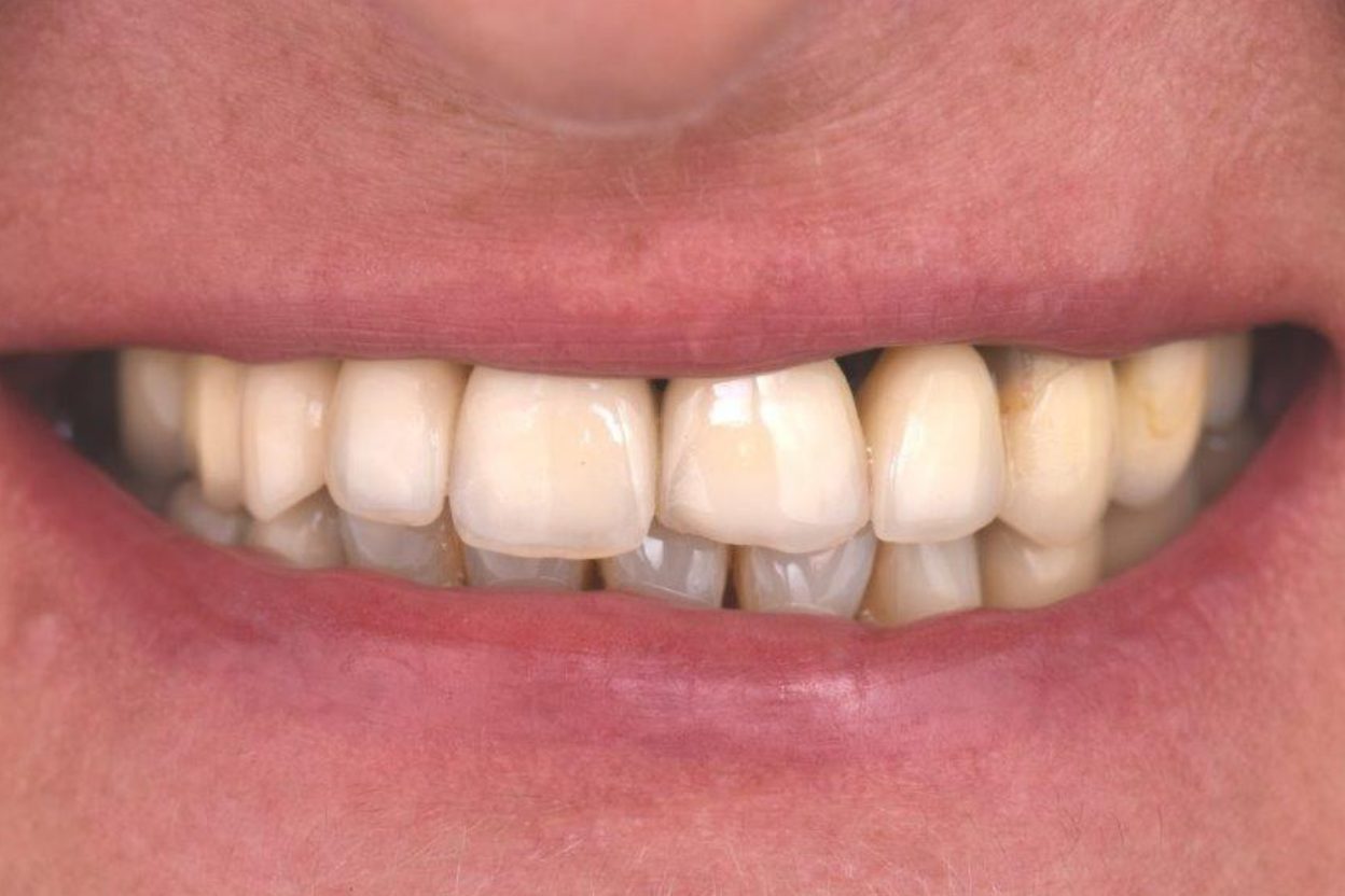 Clinica Dentária Beclinique Implante Dentário Cristovão