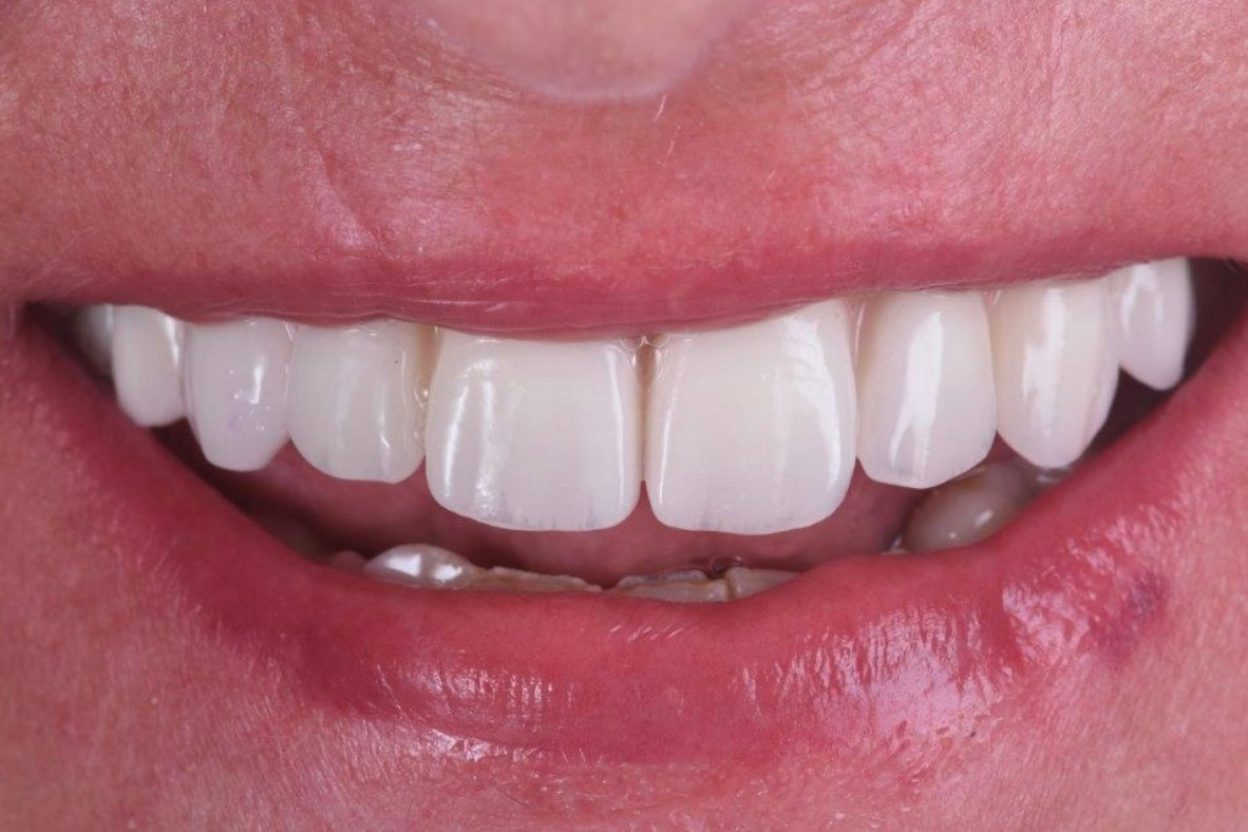 Clinica Dentária Beclinique Implante Dentário Cristovão