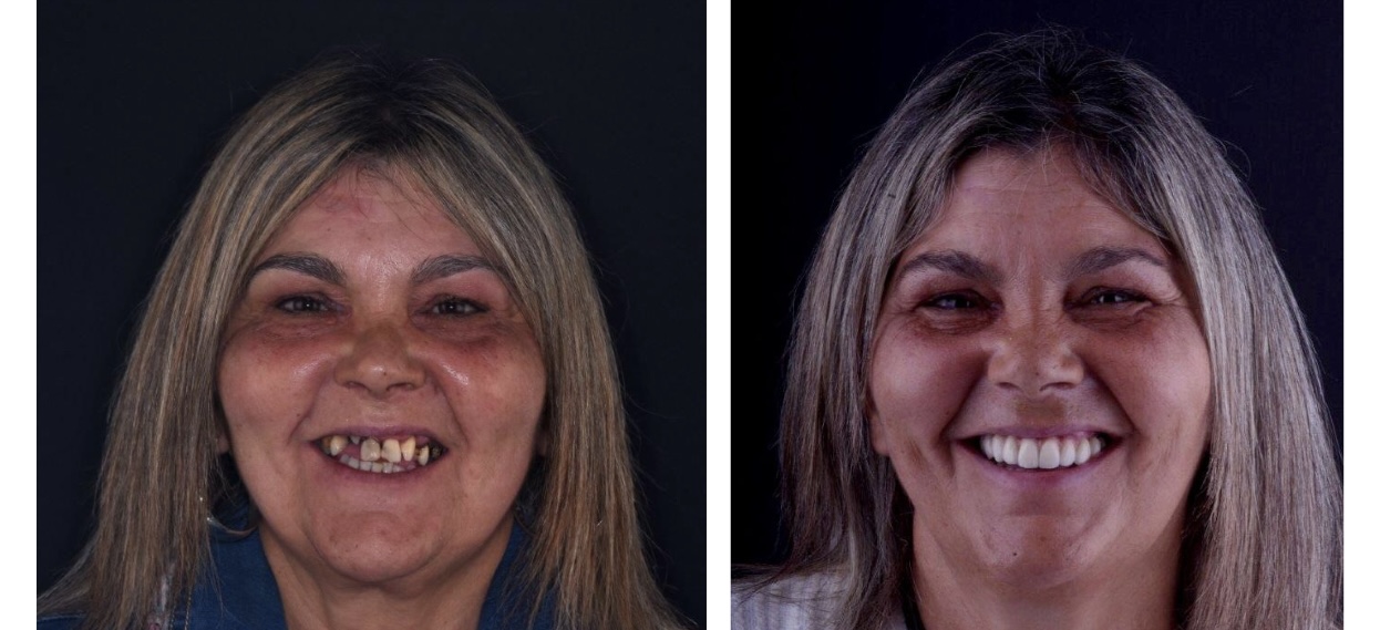Total oral rehabilitation before after Maria Santana